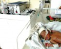 Malawian newborn using Pumani bubble CPAP device