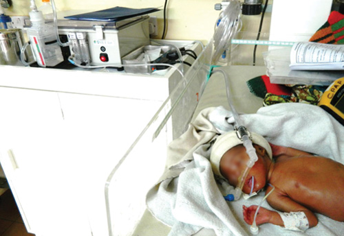Malawian newborn using Pumani bubble CPAP device