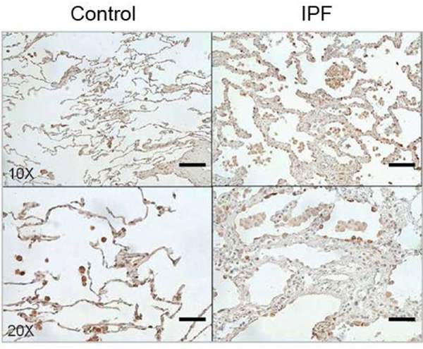 The protein CHI3L1 works to protect injured cells and to repair damage. In lung tissue, damage repair means a buildup of scar tissue, which compromises the lung. Levels of CHI3L1 are much higher in patients with idiopathic pulmonary fibrosis (right) than in healthy controls. Credit: Brown University/Yale University