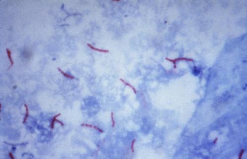 Genetic discovery provides clues to how TB may evade the immune system